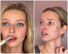 אפל מרטין חשפה את האקנה שלה, את ההזרקה שהיא מתחרטת עליה ואת "מנפח השפתיים הטוב בעולם"