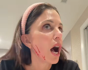 "אל תאמינו לכל מה שמקדמים": הכוכבת ניסתה מוצר טיפוח מבטיח – וזה נגמר בהרבה דם